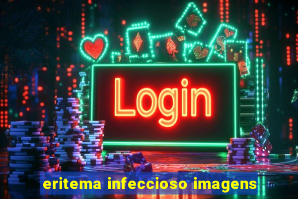 eritema infeccioso imagens